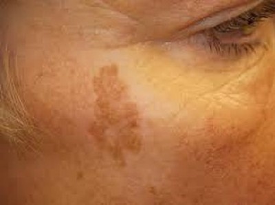 Pigmentation