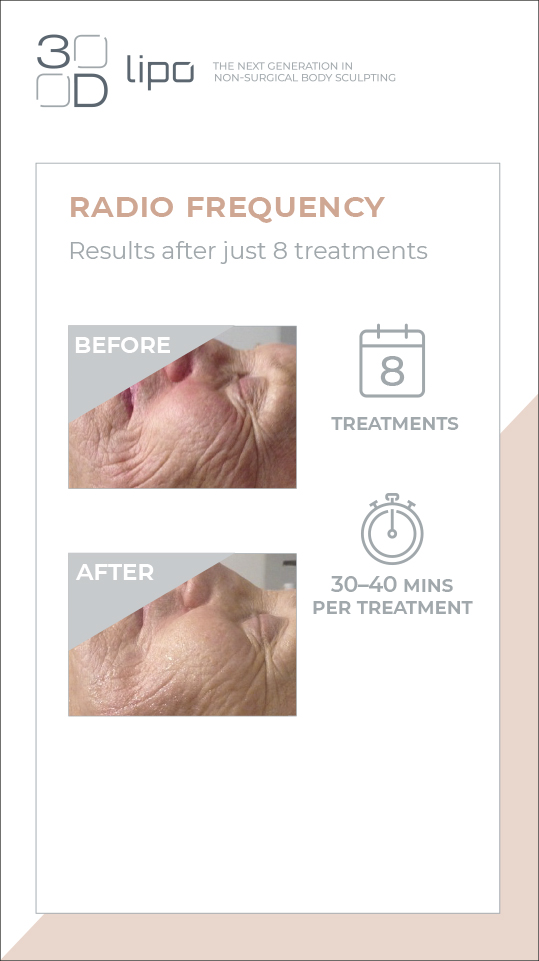 The One Lounge Treatments Radio frequency (skin tightening and fat