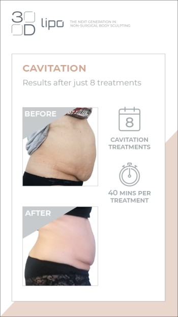 https://www.onelounge.co.uk/siteimages/ULTIMATE-PRO/resized/cavitation-results-2-350.jpg